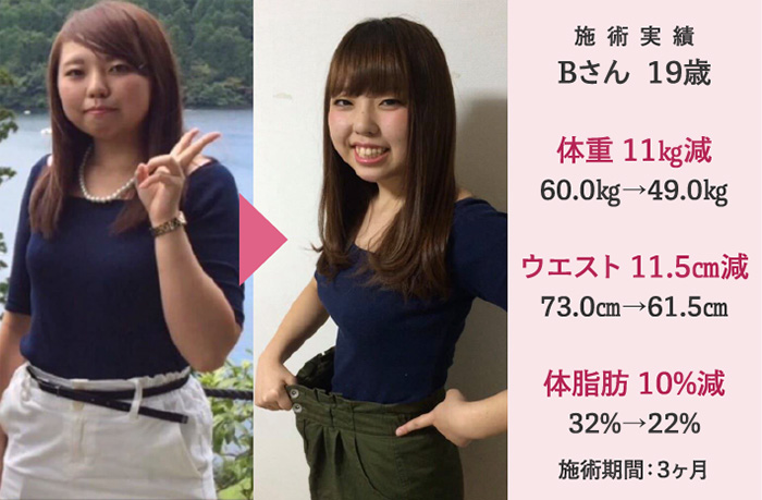 施術実績 Bさん  19歳 体重 11㎏減 60.0㎏→49.0㎏ ウエスト 11.5㎝減 73.0㎝→61.5㎝ 体脂肪 10%減 32%→22% 施術期間：３ヶ月